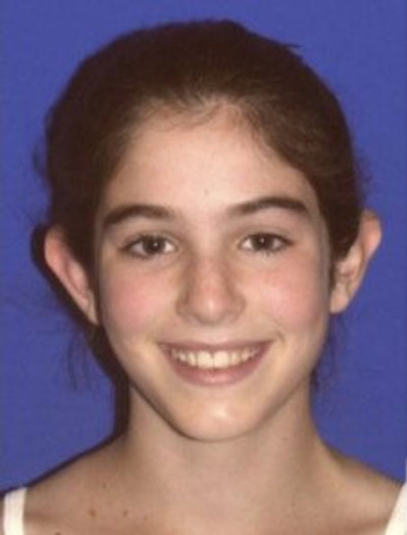 Ear Pinning Surgery Before & After Gallery - Patient 329188 - Image 1