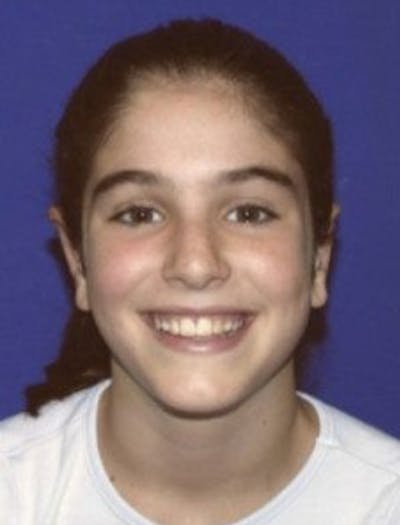 Ear Pinning Surgery Before & After Gallery - Patient 329188 - Image 2
