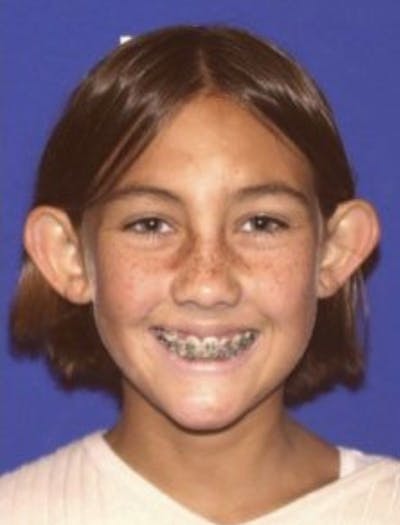 Ear Pinning Surgery Before & After Gallery - Patient 657502 - Image 1