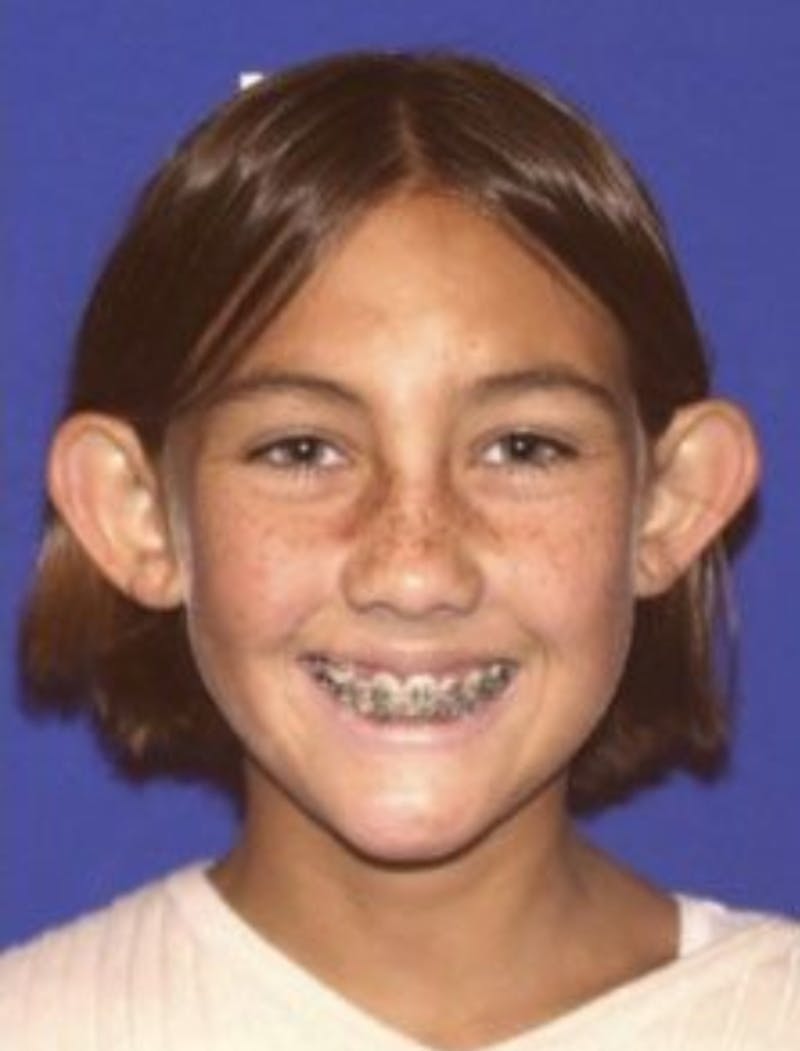 Ear Pinning Surgery Before & After Gallery - Patient 657502 - Image 1
