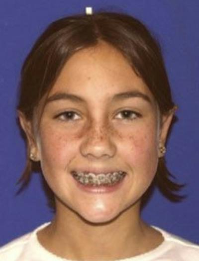 Ear Pinning Surgery Before & After Gallery - Patient 657502 - Image 2