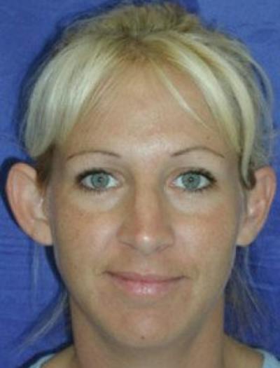 Ear Pinning Surgery Before & After Gallery - Patient 101244 - Image 1