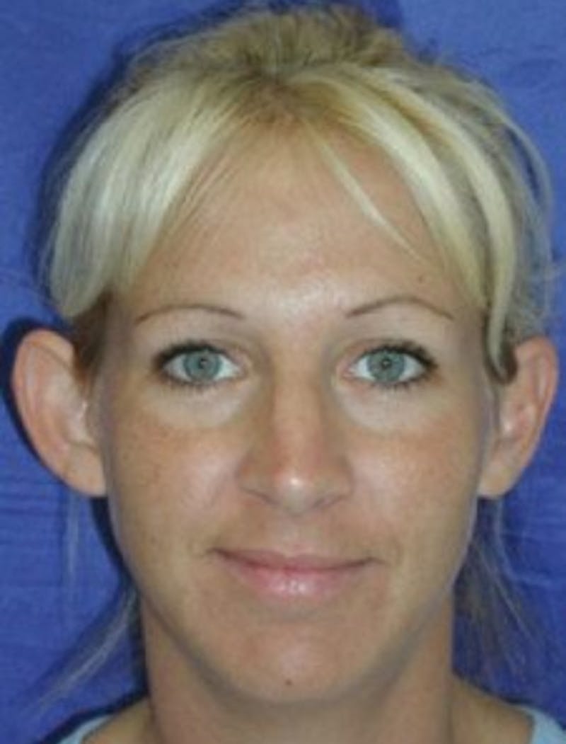 Ear Pinning Surgery Before & After Gallery - Patient 101244 - Image 1