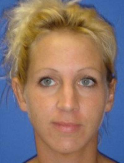 Ear Pinning Surgery Before & After Gallery - Patient 101244 - Image 2