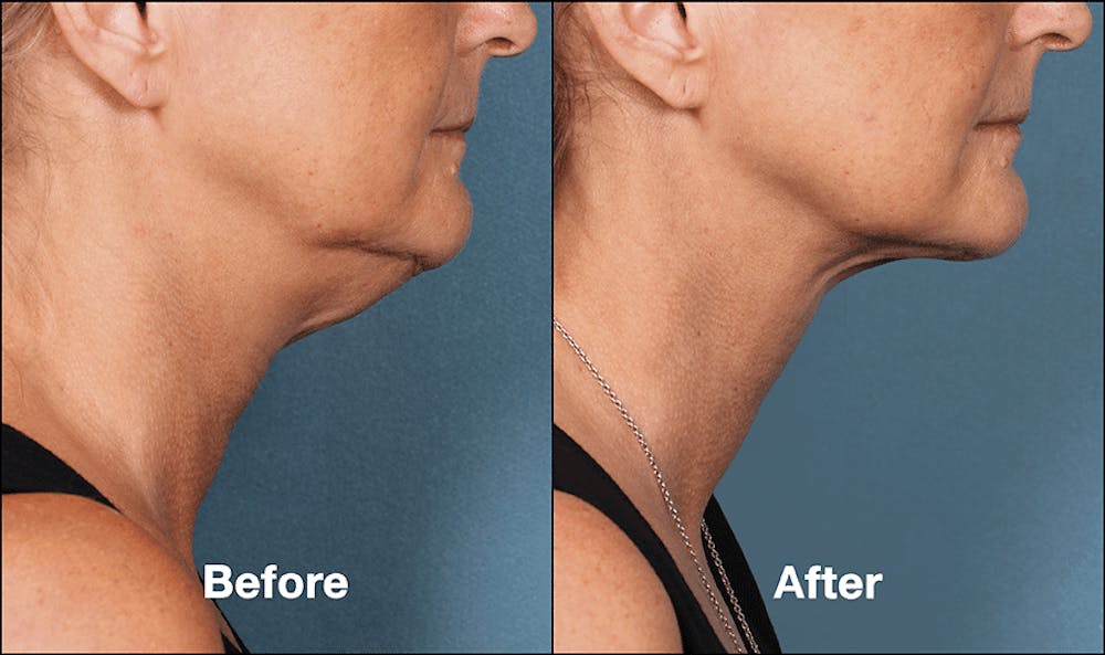 Kybella_BeforeAfter