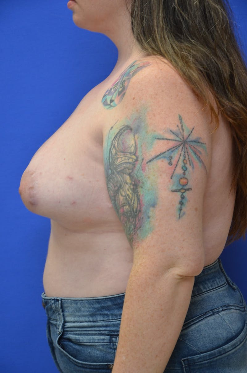Tuberous Breast Before & After Gallery - Patient 213784 - Image 2