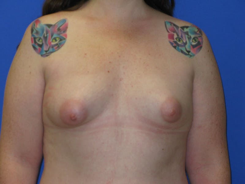 Tuberous Breast Before & After Gallery - Patient 213784 - Image 3