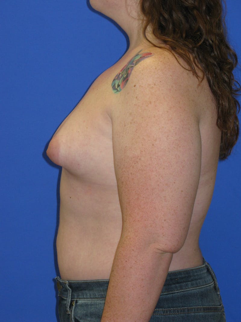 Tuberous Breast Before & After Gallery - Patient 213784 - Image 1