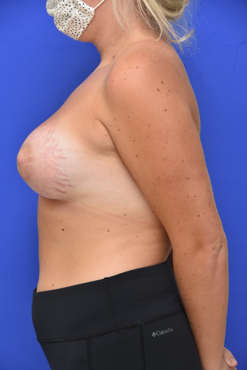 Tuberous Breast Before & After Gallery - Patient 414478 - Image 2