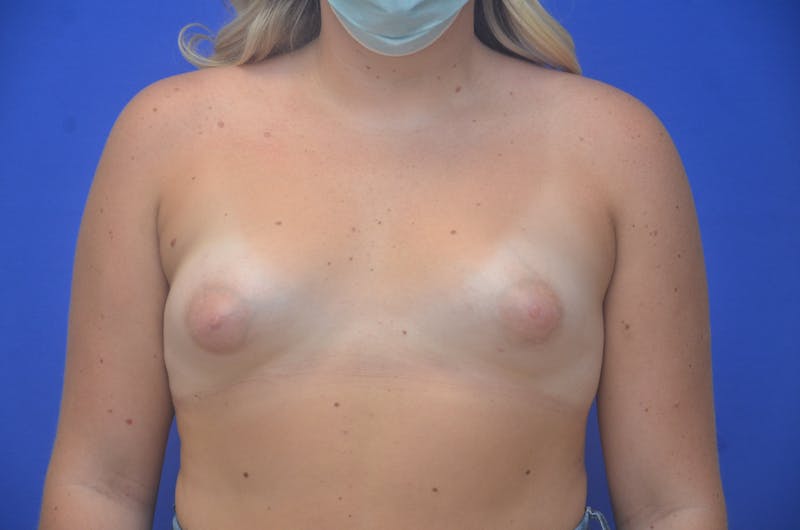 Tuberous Breast Before & After Gallery - Patient 414478 - Image 3