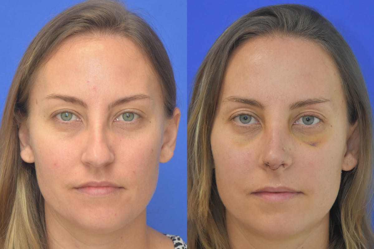 Rhinoplasty Before & After Gallery - Patient 218778 - Image 2