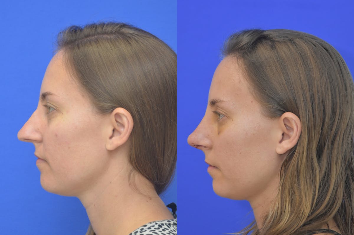 Rhinoplasty Before & After Gallery - Patient 218778 - Image 1