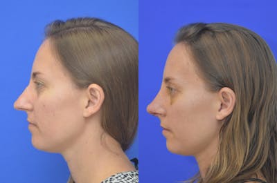 Rhinoplasty Before & After Gallery - Patient 218778 - Image 1