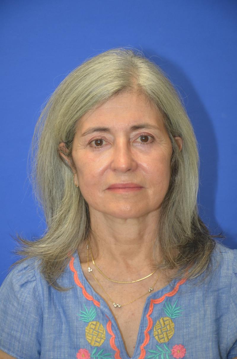 CO2 Before & After Gallery - Patient 226655 - Image 2