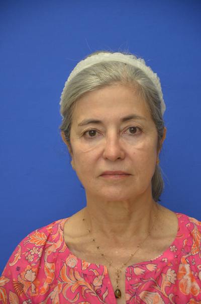 CO2 Before & After Gallery - Patient 226655 - Image 1