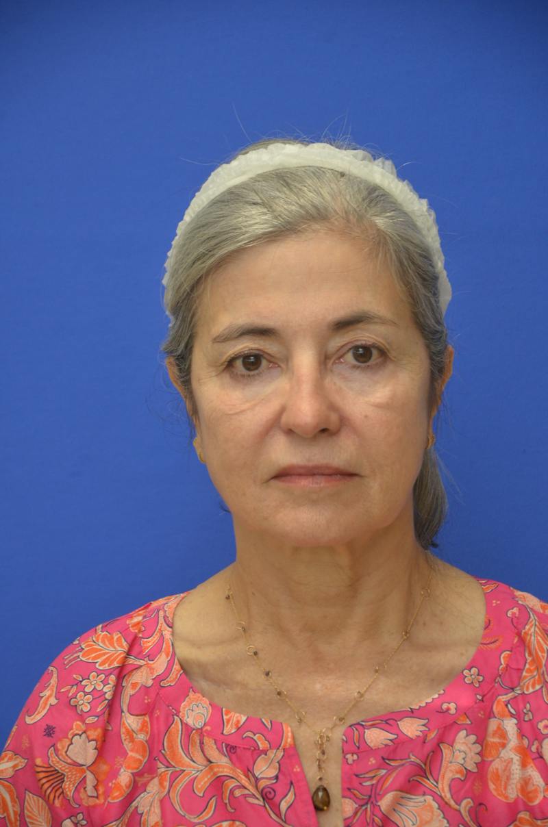 CO2 Before & After Gallery - Patient 226655 - Image 1