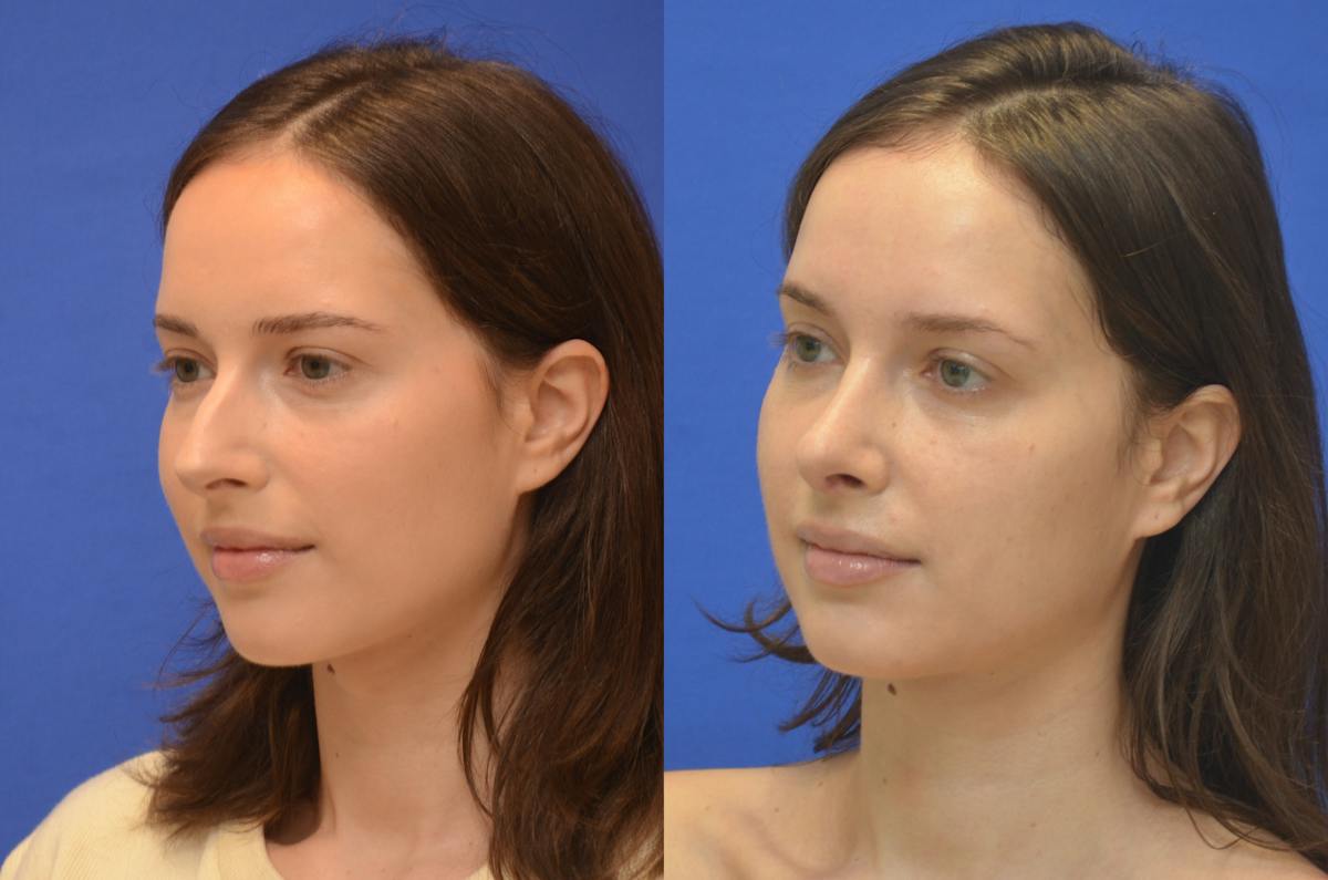 Rhinoplasty Before & After Gallery - Patient 357008 - Image 1