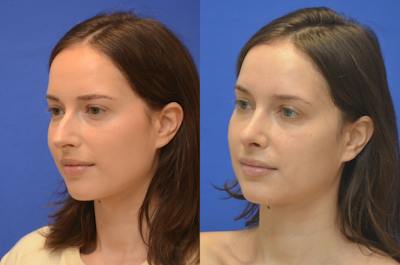 Rhinoplasty Before & After Gallery - Patient 357008 - Image 1