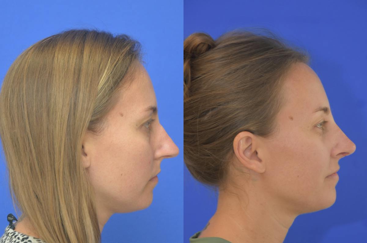 Rhinoplasty Before & After Gallery - Patient 771409 - Image 1