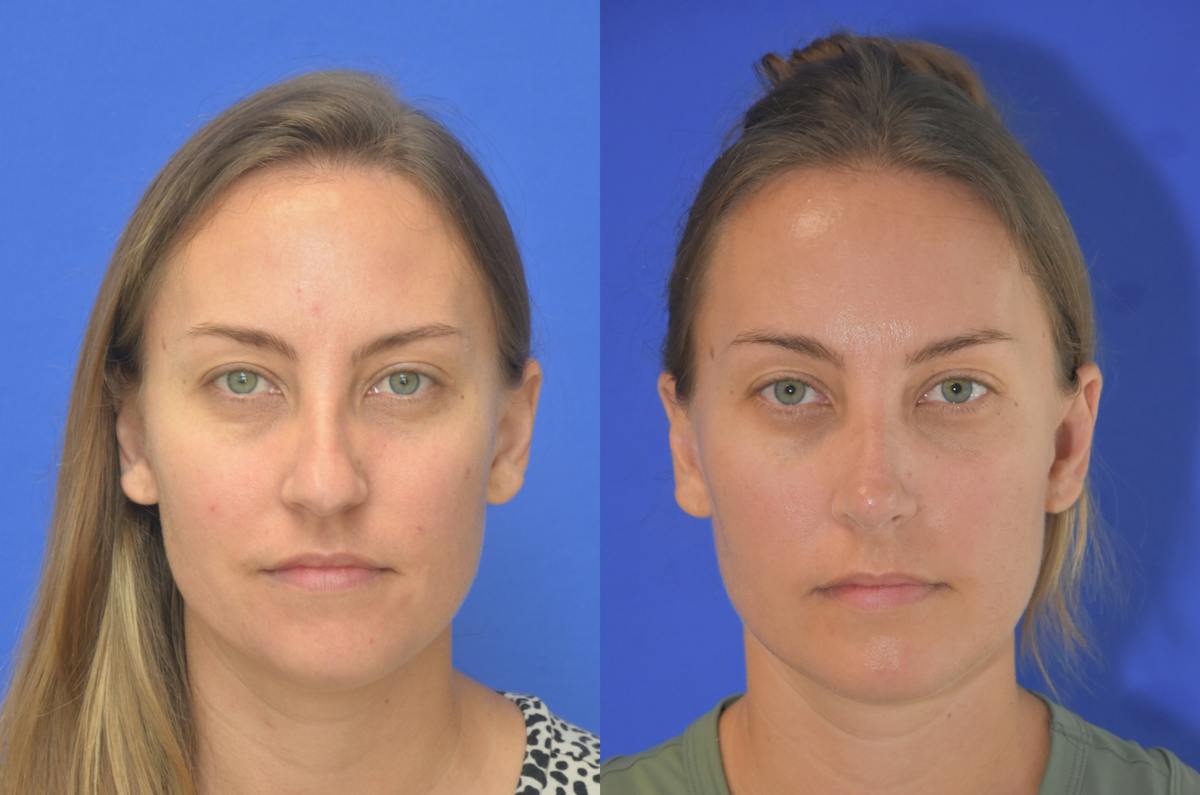 Rhinoplasty Before & After Gallery - Patient 771409 - Image 2