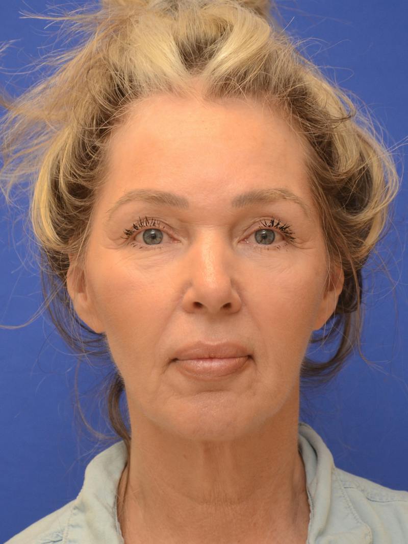  Mini-Facelift Before & After Gallery - Patient 405851 - Image 1