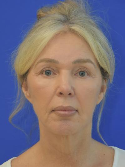  Mini-Facelift Before & After Gallery - Patient 405851 - Image 2