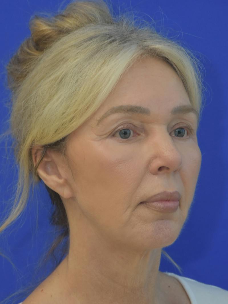  Mini-Facelift Before & After Gallery - Patient 405851 - Image 4
