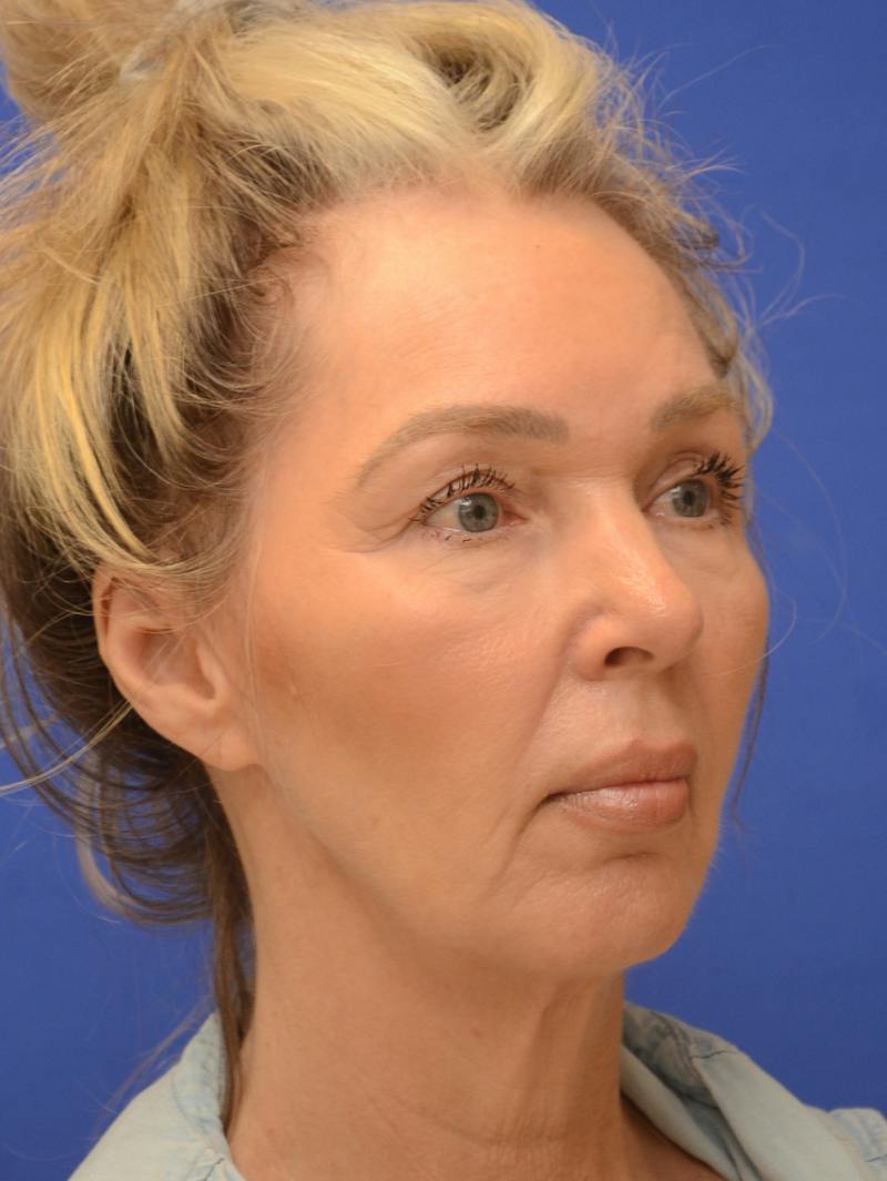  Mini-Facelift Before & After Gallery - Patient 405851 - Image 3