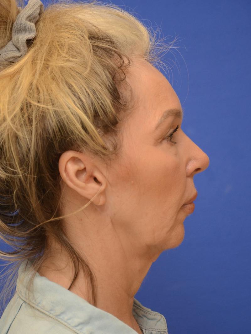  Mini-Facelift Before & After Gallery - Patient 405851 - Image 5