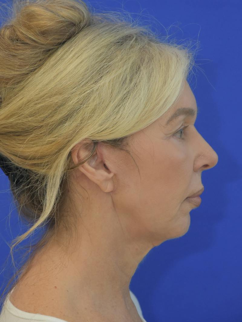  Mini-Facelift Before & After Gallery - Patient 405851 - Image 6