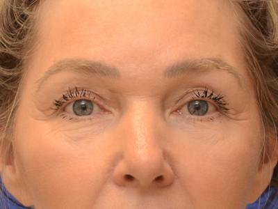 Blepharoplasty Before & After Gallery - Patient 336861 - Image 1
