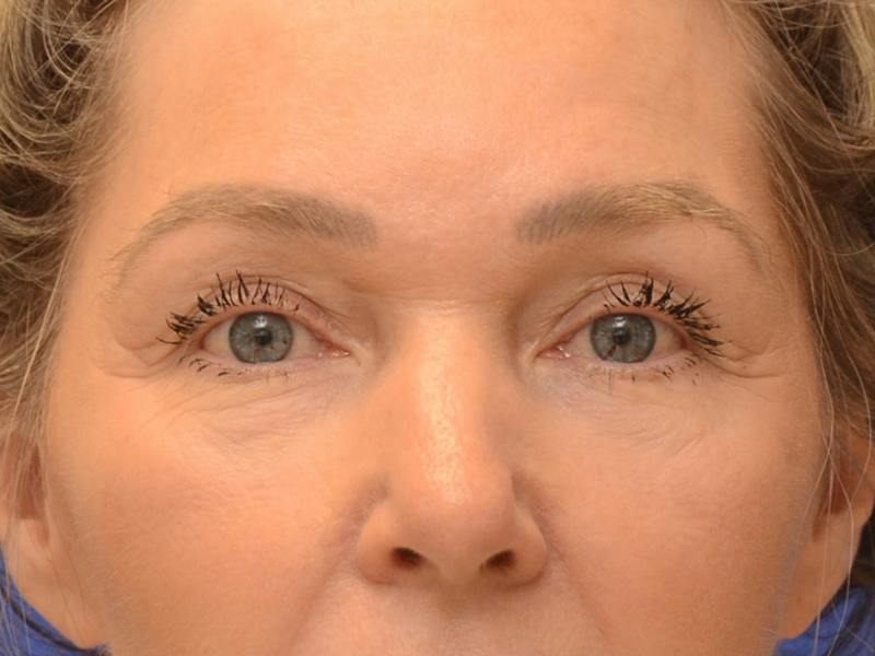 Blepharoplasty Before & After Gallery - Patient 336861 - Image 1