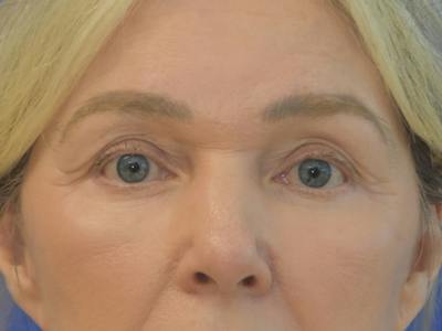 Blepharoplasty Before & After Gallery - Patient 336861 - Image 2