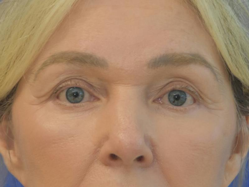 Blepharoplasty Before & After Gallery - Patient 336861 - Image 2