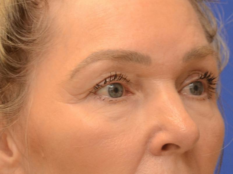 Blepharoplasty Before & After Gallery - Patient 336861 - Image 3