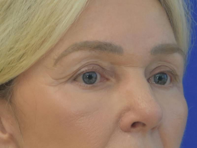 Blepharoplasty Before & After Gallery - Patient 336861 - Image 4