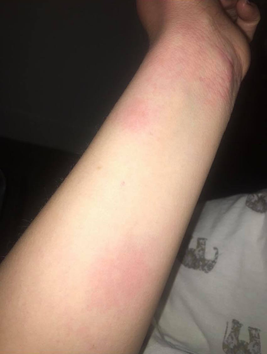 extended arm with red patches of hives and eczema 