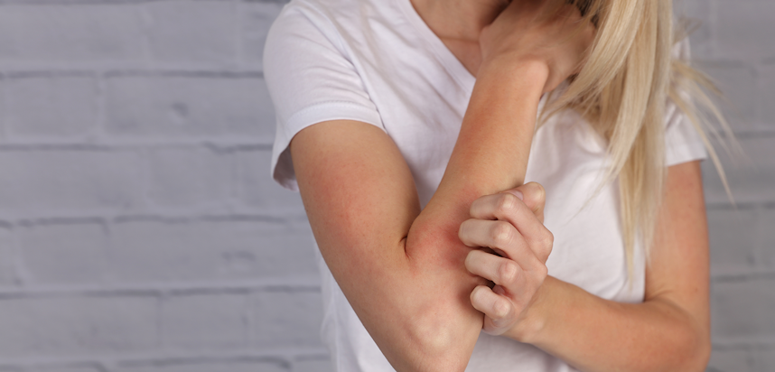 Allergen Deep Dive: Sulphur Dioxide - A person experiencing an allergic reaction or intolerance to sulphites Allergen Deep Dive: Sulphur Dioxide - A person experiencing an allergic reaction or intolerance to sulphites