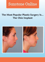 Before and After Chin Implant