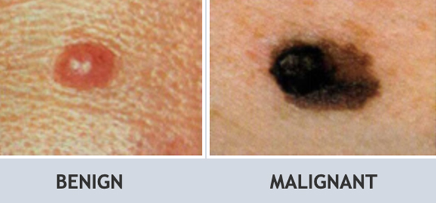 skin cancer moles on arms