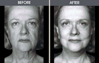 Facelift and Mini Facelift Before & After Gallery - Patient 2206146 - Image 1