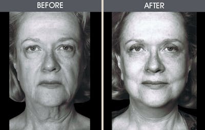 Facelift and Mini Facelift Before & After Gallery - Patient 2206146 - Image 1