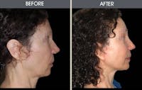 Facelift and Mini Facelift Before & After Gallery - Patient 2206167 - Image 1