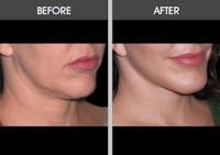 Facelift and Mini Facelift Gallery Before & After Gallery - Patient 2206186 - Image 1