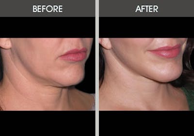 Facelift and Mini Facelift Gallery Before & After Gallery - Patient 2206186 - Image 1