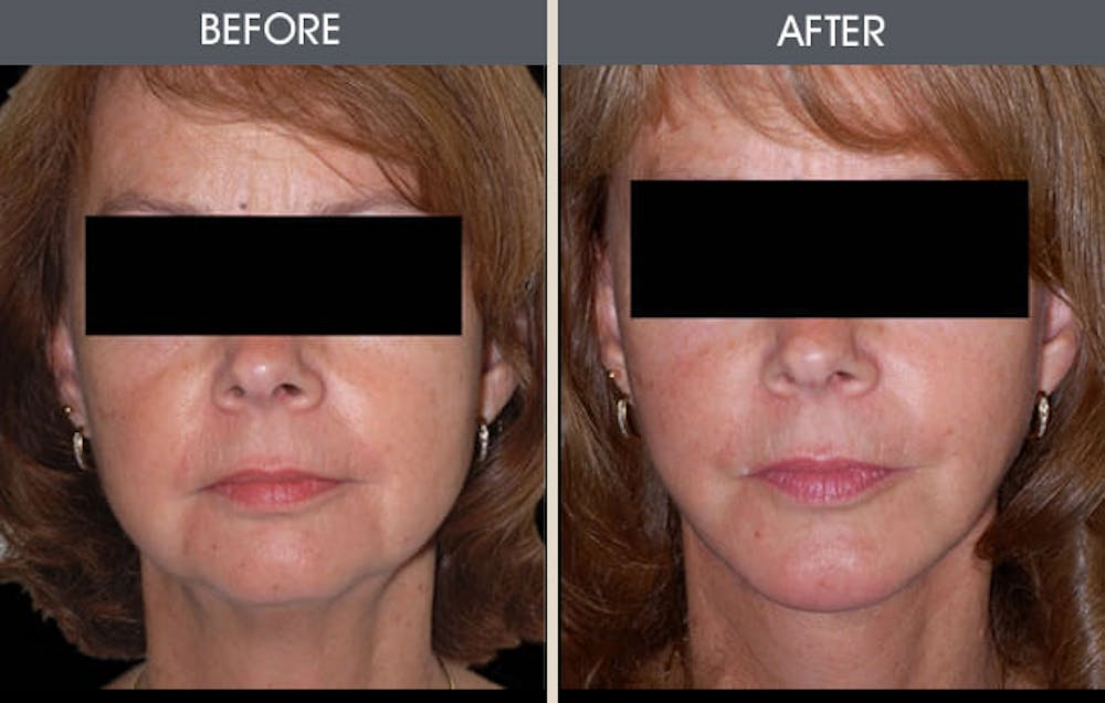 Facelift Before & After Gallery - Patient 2206199 - Image 1