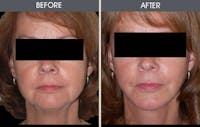 Facelift and Mini Facelift Before & After Gallery - Patient 2206199 - Image 1