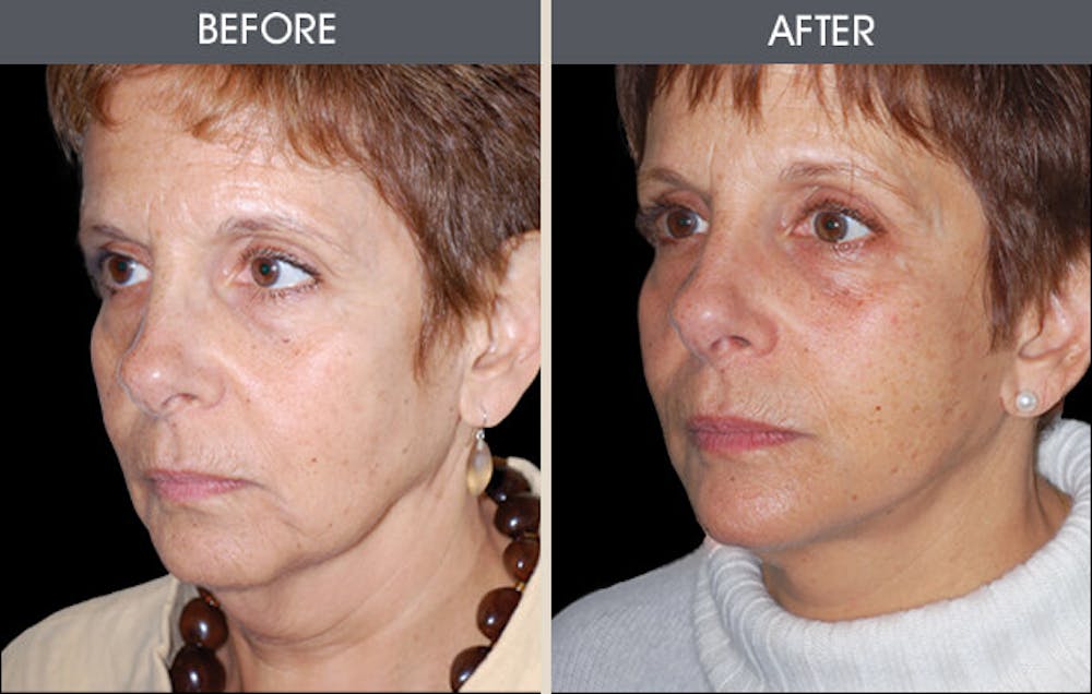 Facelift and Mini Facelift Gallery Before & After Gallery - Patient 2206273 - Image 1