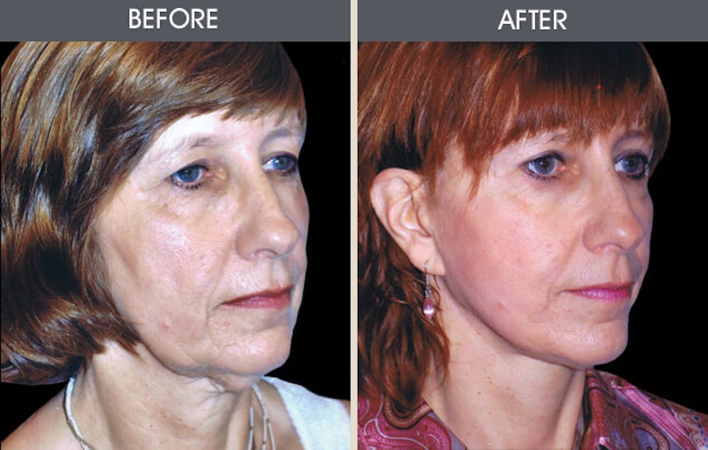 Facelift and Mini Facelift Gallery Before & After Gallery - Patient 2206289 - Image 1