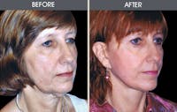Facelift and Mini Facelift Gallery Before & After Gallery - Patient 2206289 - Image 1